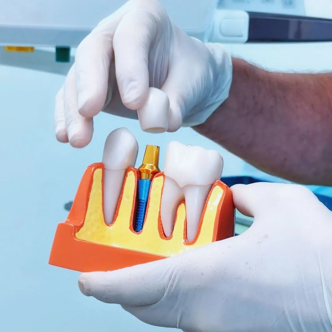 impianto dentale a Magenta e Segrate - - Studio dentistico ad Abbiategrasso - studio dentistico a Corbetta - studio dentistico a Pioltello - studio dentistico a Cernusco sul Naviglio