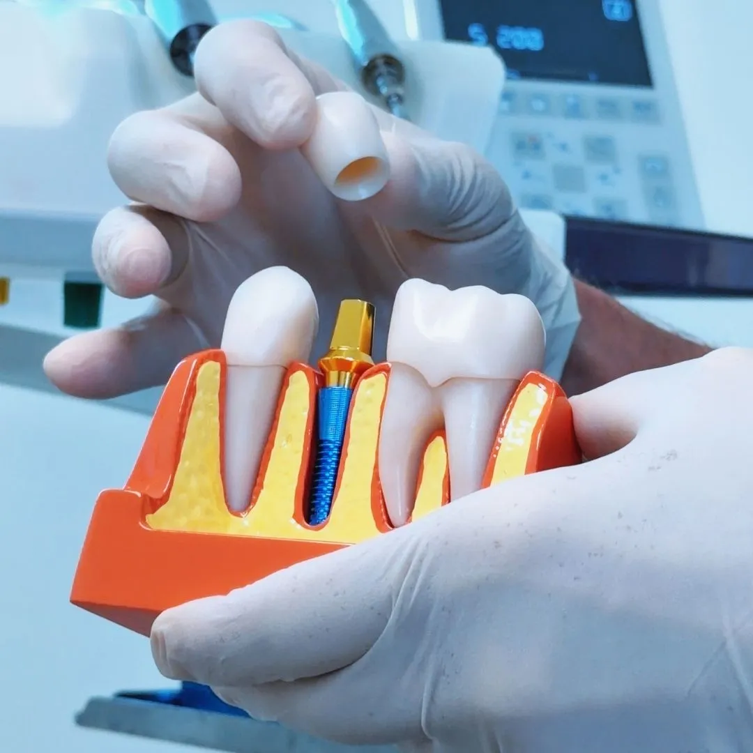 impianto dentale a Magenta e Segrate